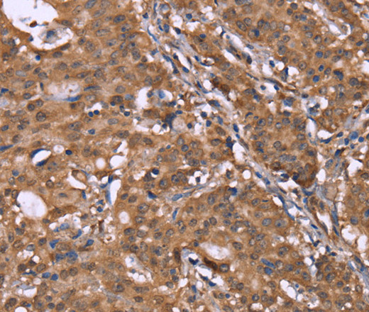 Immunohistochemistry of paraffin-embedded Human gasrtic cancer tissue using HLTF Polyclonal Antibody at dilution 1:40