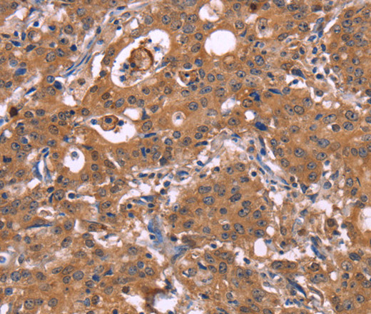 Immunohistochemistry of paraffin-embedded Human gasrtic cancer tissue using HMGCS1 Polyclonal Antibody at dilution 1:40