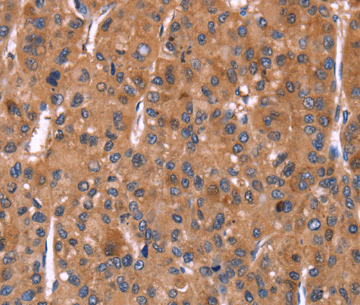 Immunohistochemistry of paraffin-embedded Human liver cancer tissue using HMGCS1 Polyclonal Antibody at dilution 1:40