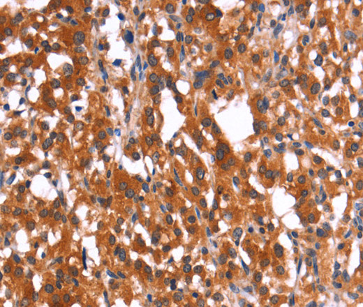 Immunohistochemistry of paraffin-embedded Human thyroid cancer using HMGCS2 Polyclonal Antibody at dilution of 1:40