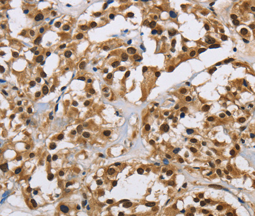 Immunohistochemistry of paraffin-embedded Human thyroid cancer using HNRNP L Polyclonal Antibody at dilution of 1:40