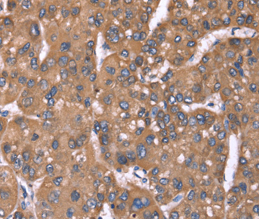 Immunohistochemistry of paraffin-embedded Human liver cancer tissue using HRG Polyclonal Antibody at dilution 1:50