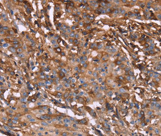 Immunohistochemistry of paraffin-embedded Human gasrtic cancer tissue using HP Polyclonal Antibody at dilution 1:40