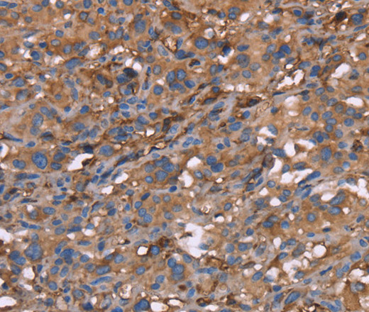 Immunohistochemistry of paraffin-embedded Human thyroid cancer tissue using HP Polyclonal Antibody at dilution 1:40