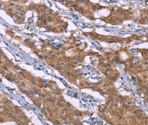 Immunohistochemistry of paraffin-embedded Human gasrtic cancer tissue using Histamine H3 Receptor Polyclonal Antibody at dilution 1:40