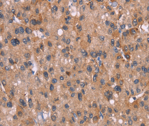 Immunohistochemistry of paraffin-embedded Human liver cancer tissue using Histamine H3 Receptor Polyclonal Antibody at dilution 1:40