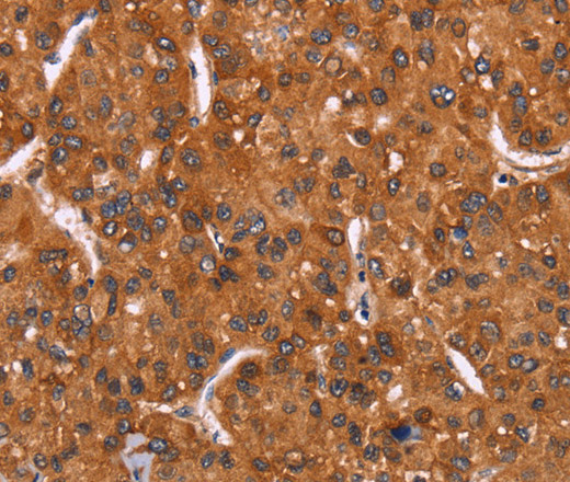 Immunohistochemistry of paraffin-embedded Human liver cancer tissue using HRK Polyclonal Antibody at dilution 1:40