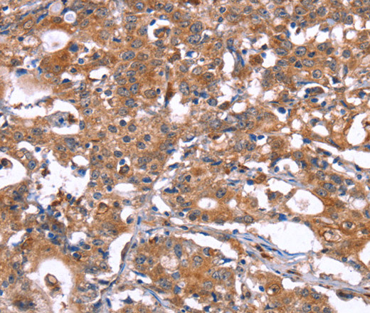 Immunohistochemistry of paraffin-embedded Human gastric cancer using HSD17B1 Polyclonal Antibody at dilution of 1:40