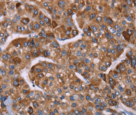 Immunohistochemistry of paraffin-embedded Human liver cancer tissue using HSP10 Polyclonal Antibody at dilution 1:40