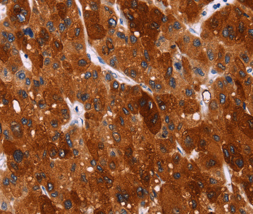 Immunohistochemistry of paraffin-embedded Human liver cancer tissue using HSPB6 Polyclonal Antibody at dilution 1:40