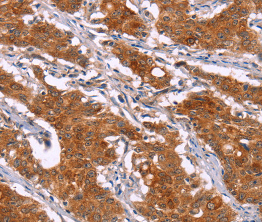 Immunohistochemistry of paraffin-embedded Human gastric cancer tissue using HSPB6 Polyclonal Antibody at dilution 1:40