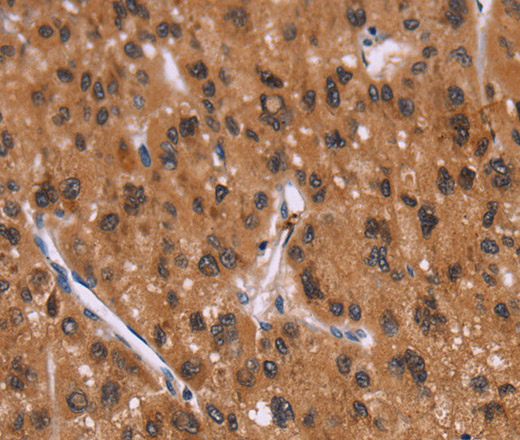 Immunohistochemistry of paraffin-embedded Human liver cancer tissue using ID2 Polyclonal Antibody at dilution 1:30