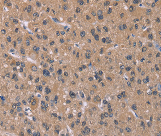 Immunohistochemistry of paraffin-embedded Human thyroid cancer tissue using IFNA2 Polyclonal Antibody at dilution 1:40