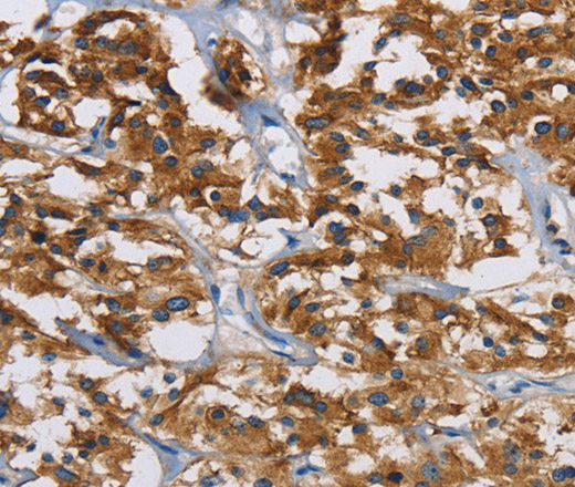 Immunohistochemistry of paraffin-embedded Human thyroid cancer tissue using IGF2R Polyclonal Antibody at dilution 1:40