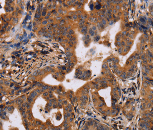 Immunohistochemistry of paraffin-embedded Human gasrtic cancer tissue using IL12RB2 Polyclonal Antibody at dilution 1:40