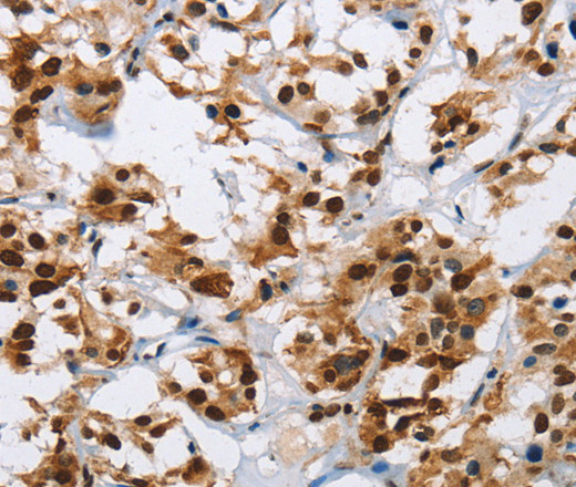 Immunohistochemistry of paraffin-embedded Human thyroid cancer using IL17C Polyclonal Antibody at dilution of 1:50