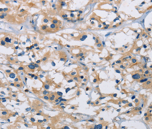 Immunohistochemistry of paraffin-embedded Human thyroid cancer using IL17RB Polyclonal Antibody at dilution of 1:40