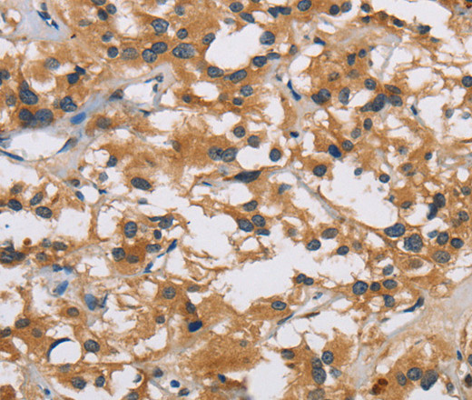 Immunohistochemistry of paraffin-embedded Human thyroid cancer using IL19 Polyclonal Antibody at dilution of 1:40