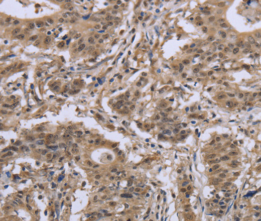 Immunohistochemistry of paraffin-embedded Human gasrtic cancer tissue using IPO8 Polyclonal Antibody at dilution 1:50