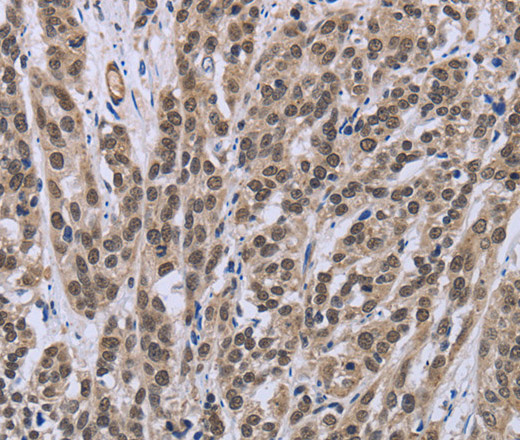 Immunohistochemistry of paraffin-embedded Human esophagus cancer tissue using IPO8 Polyclonal Antibody at dilution 1:50