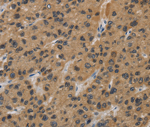 Immunohistochemistry of paraffin-embedded Human liver cancer tissue using INPPL1 Polyclonal Antibody at dilution 1:40