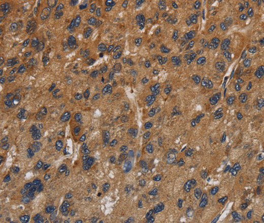 Immunohistochemistry of paraffin-embedded Human gastric cancer using ITGB7 Polyclonal Antibody at dilution of 1:40