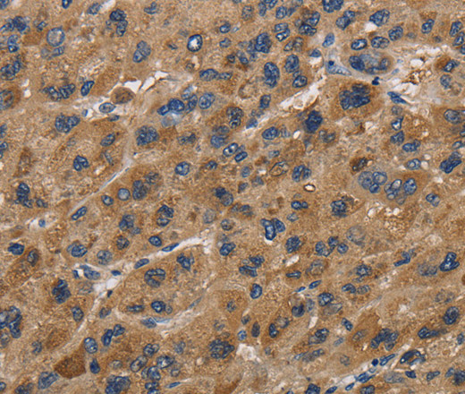 Immunohistochemistry of paraffin-embedded Human liver cancer using FABP2 Polyclonal Antibody at dilution of 1:40