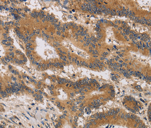 Immunohistochemistry of paraffin-embedded Human colon cancer tissue using ITIH1 Polyclonal Antibody at dilution of 1:30