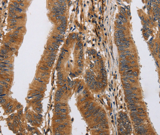 Immunohistochemistry of paraffin-embedded Human colon cancer tissue using ITPR1 Polyclonal Antibody at dilution 1:40