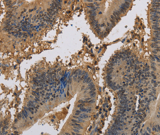 Immunohistochemistry of paraffin-embedded Human colon cancer tissue using KCNA7 Polyclonal Antibody at dilution 1:40