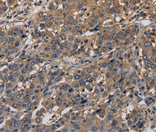 Immunohistochemistry of paraffin-embedded Human liver cancer tissue using KCNA7 Polyclonal Antibody at dilution 1:40