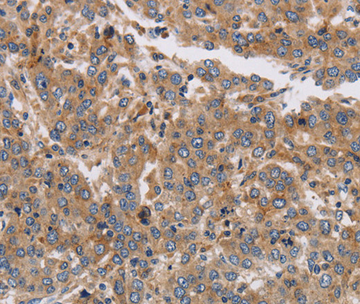 Immunohistochemistry of paraffin-embedded Human liver cancer tissue using KCNG1 Polyclonal Antibody at dilution 1:40