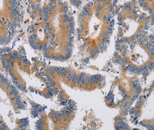 Immunohistochemistry of paraffin-embedded Human colon cancer tissue using KCNG1 Polyclonal Antibody at dilution 1:40