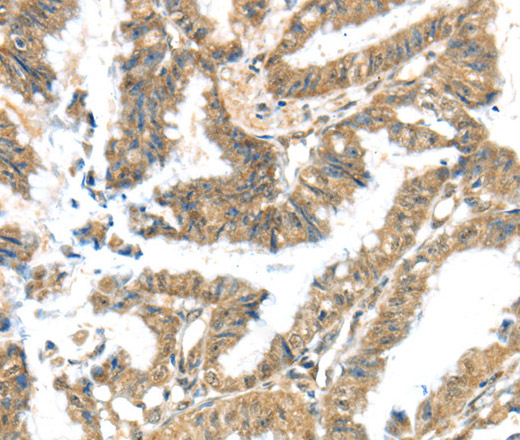 Immunohistochemistry of paraffin-embedded Human colon cancer tissue using KCNG3 Polyclonal Antibody at dilution 1:40