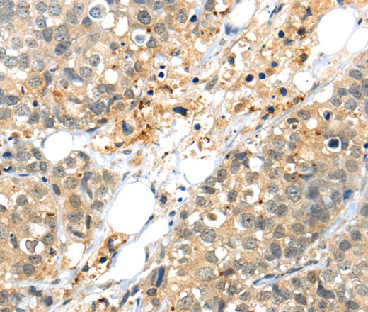 Immunohistochemistry of paraffin-embedded Human liver cancer tissue using KCNG3 Polyclonal Antibody at dilution 1:40