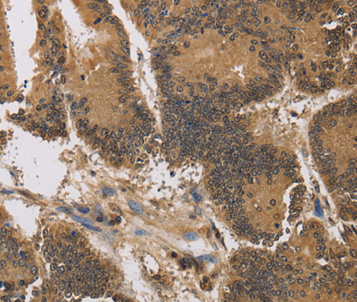 Immunohistochemistry of paraffin-embedded Human colon cancer using KCNG4 Polyclonal Antibody at dilution of 1:40