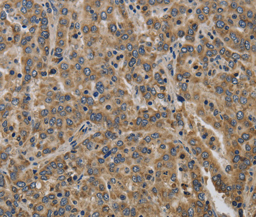 Immunohistochemistry of paraffin-embedded Human liver cancer tissue using KCNMB2 Polyclonal Antibody at dilution 1:40