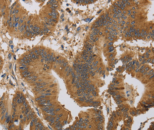 Immunohistochemistry of paraffin-embedded Human colon cancer using KCNMB4 Polyclonal Antibody at dilution of 1:30