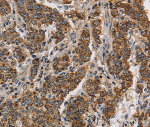 Immunohistochemistry of paraffin-embedded Human liver cancer using KCNQ4 Polyclonal Antibody at dilution of 1:40