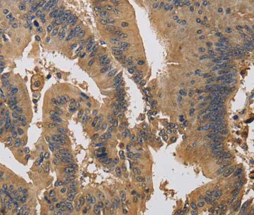 Immunohistochemistry of paraffin-embedded Human colon cancer using KIF22 Polyclonal Antibody at dilution of 1:30