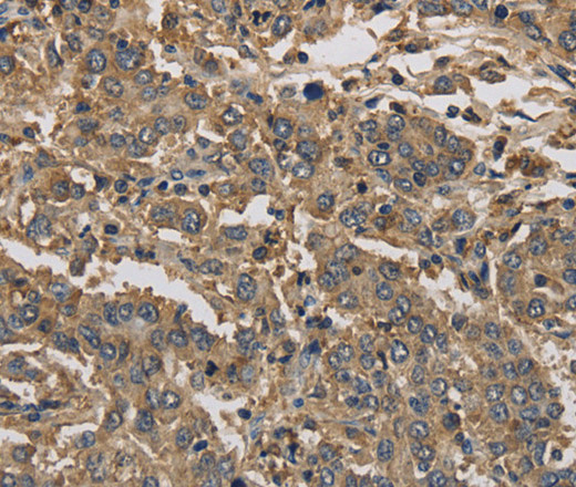 Immunohistochemistry of paraffin-embedded Human liver cancer using KIF22 Polyclonal Antibody at dilution of 1:30