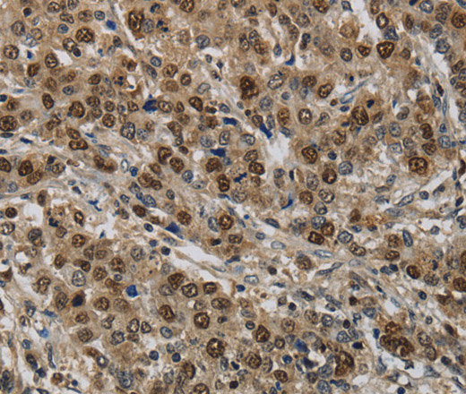 Immunohistochemistry of paraffin-embedded Human liver cancer tissue using KIF4A Polyclonal Antibody at dilution 1:40