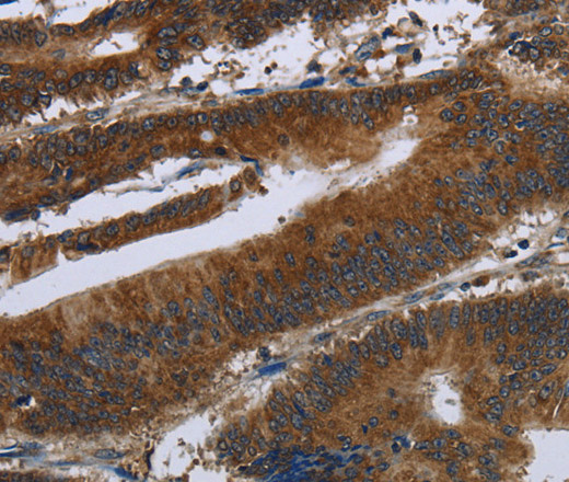 Immunohistochemistry of paraffin-embedded Human colon cancer tissue using ARHGEF12 Polyclonal Antibody at dilution 1:30