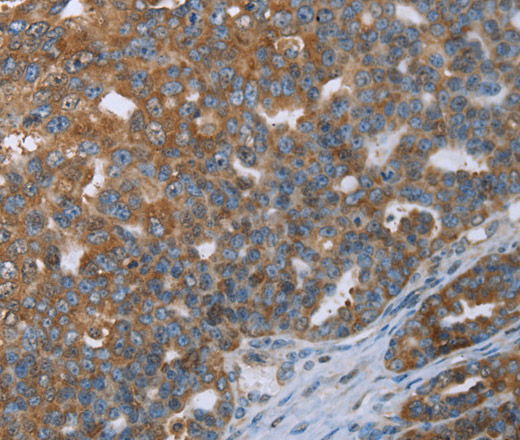 Immunohistochemistry of paraffin-embedded Human ovarian cancer tissue using CERS4 Polyclonal Antibody at dilution 1:35