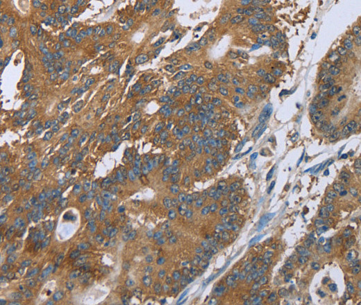 Immunohistochemistry of paraffin-embedded Human colon cancer tissue using CERS4 Polyclonal Antibody at dilution 1:35