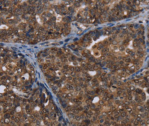 Immunohistochemistry of paraffin-embedded Human ovarian cancer tissue using CERS6 Polyclonal Antibody at dilution 1:35