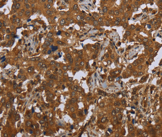 Immunohistochemistry of paraffin-embedded Human liver cancer tissue using SCGB1D2 Polyclonal Antibody at dilution 1:40