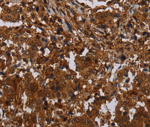 Immunohistochemistry of paraffin-embedded Human liver cancer tissue using MAGEB18 Polyclonal Antibody at dilution 1:30