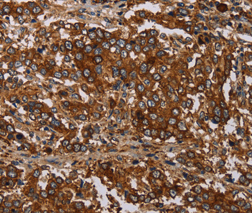 Immunohistochemistry of paraffin-embedded Human liver cancer tissue using MAGEC2 Polyclonal Antibody at dilution 1:40