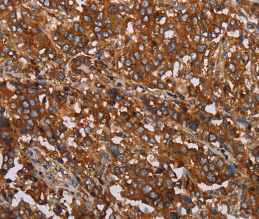 Immunohistochemistry of paraffin-embedded Human liver cancer tissue using MFAP5 Polyclonal Antibody at dilution 1:40